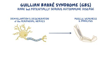 Guillain Barré syndrome Nursing Osmosis Video Library