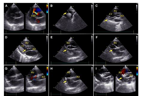 Figure 2 From Comparison Of Perventricular And Percutaneous Ultrasound