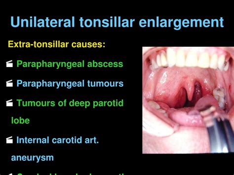 Ppt Anatomy Of Tonsil And Acute Tonsillitis Powerpoint Presentation