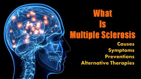 Multiple Sclerosis System Disorder Template