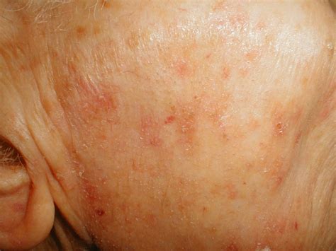 Actinic Keratosis Pictures Causes And Treatment 2020