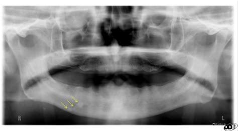 Case Of The Week Sialolith Dr Gs Toothpix