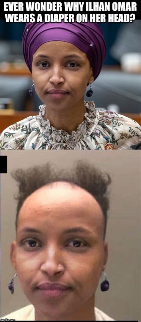 Bald Congresswoman Blames Alopecia For Her Baldness