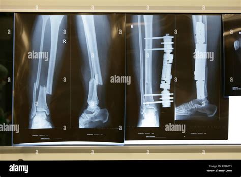 Leg Fracture External Fixation Hi Res Stock Photography And Images Alamy
