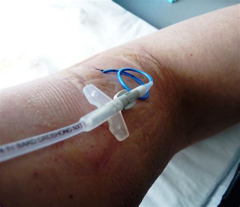 5 Tips For Living Life With A Picc Line
