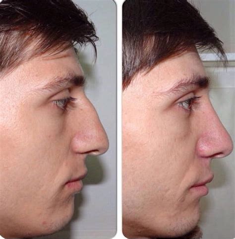 Before And After Nose Contouring 1 Rhinoplasty Cost Pics Reviews