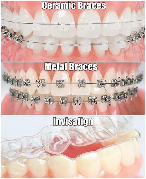 Dentist Cape Town 🇿🇦 On Instagram “all Types Of Braces Available At Kdc Call Us On 📞021