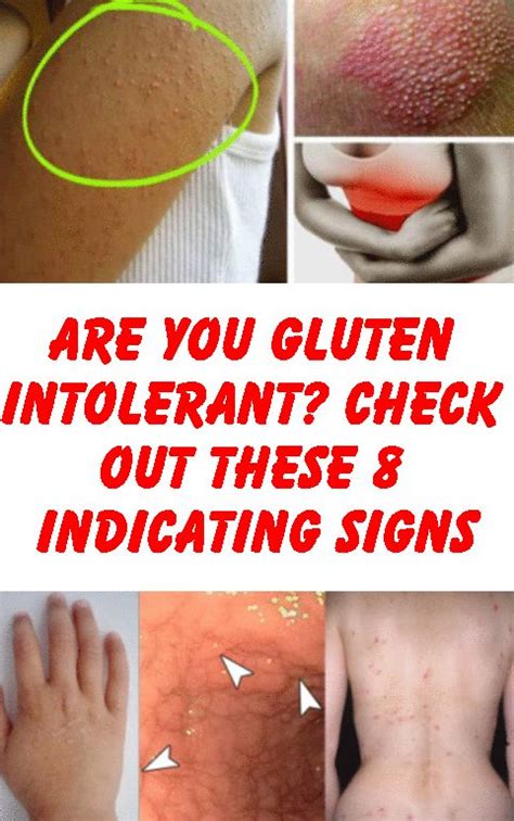 Are You Gluten Intolerant Check Out These 8 Indicating Signs Gluten