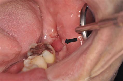 A Rare Case Of Pyogenic Granuloma In The Tooth Extraction Socket