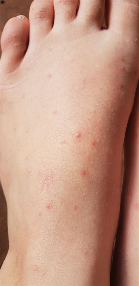 Small Itchy Bites All Over Top Of Feet Rbugbites