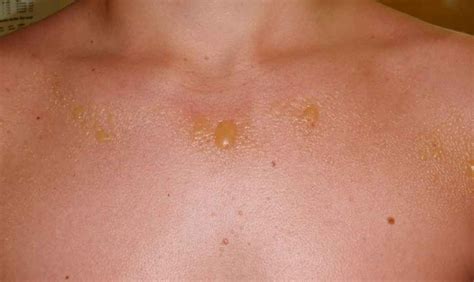 Sun Poisoning Causes Rash Pictures Treatment Remedies
