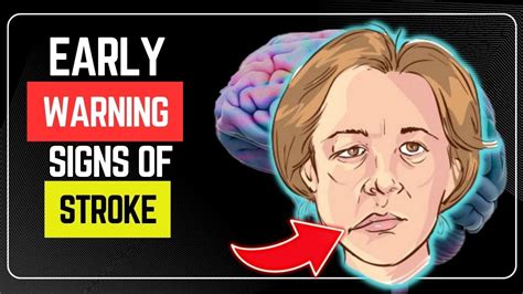 Dont Ignore These 10 Early Warning Signs Of Stroke Dangerous Youtube