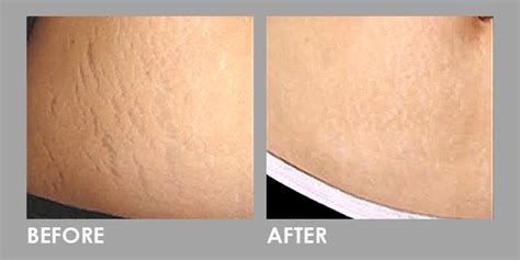 Laser Away Your Stretch Mark Premier Clinic