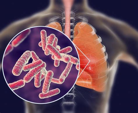 Pneumonie Symptômes Contagion Causes Traitements