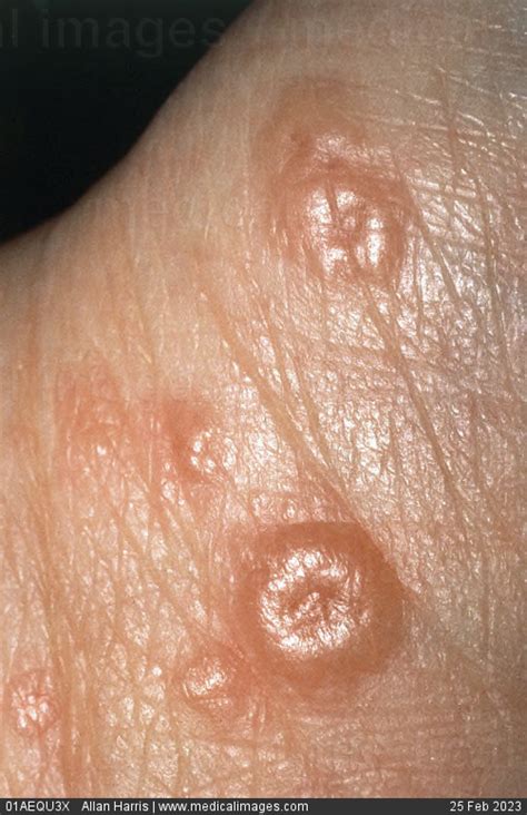 Stock Image Close Up Of Erythema Multiforme Showing Bullous Lesions