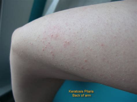 Danas Healing Journey Keratosis Pilaris