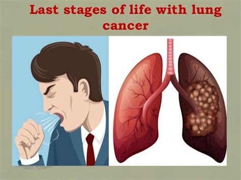 Final Stages Of Life With Lung Cancer