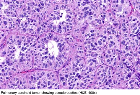 Pathology Outlines Typical Carcinoid Tumor Neuroendocrine Tumor