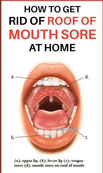burns and bumps roof of mouth sore mouth sores mouth ulcers