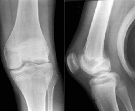 Figure From Osteochondral Fractures Of The Knee In Skeletally Immature Patients Short Term