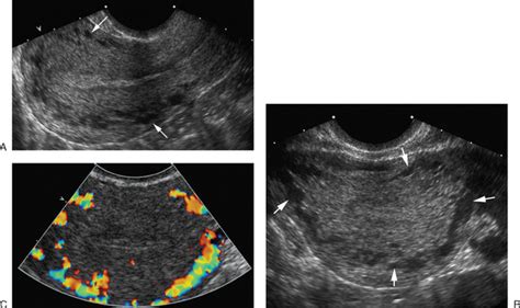 ultrasound evaluation of the uterus radiology key