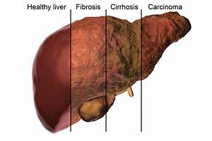 Cirrhosis, Now Linked to NAFLD, Presents Management Challenges - Texas Liver Institute Cirrhosis  