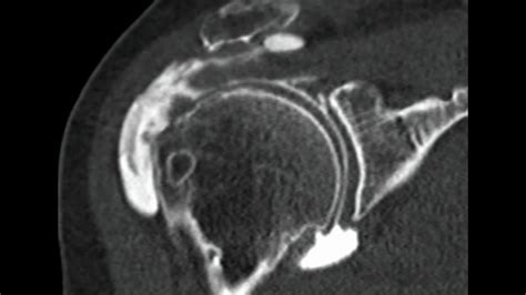 Rotator Cuff Tear And Impingement Syndrome Ct Arthrogram Finding