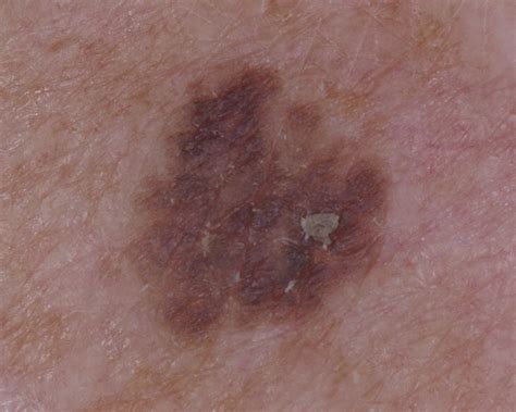 Streaks In Pigmented Squamous Cell Carcinoma In Situ Journal Of The