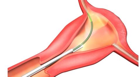 All About Hysteroscopy