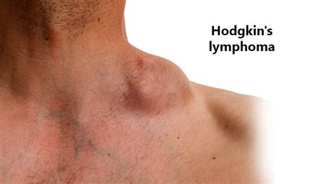 Must Know Facts On Treating Hodgkins Lymphoma