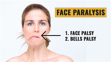 Bells Palsy Facial Palsy Signs And Symptoms Dr Dharna Physiotherapist Bawa Hursing Home