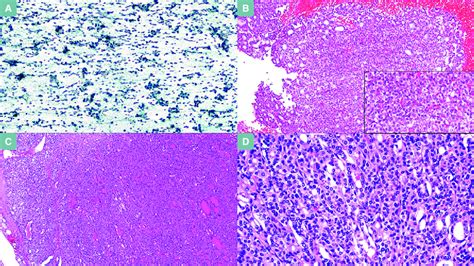 Noninvasive Follicular Thyroid Neoplasms With Papillary Like Nuclear