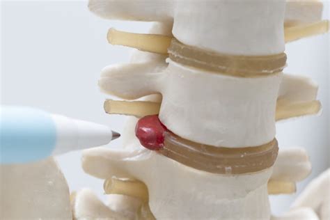 Different Types Of Spine Surgery Paganinstitute