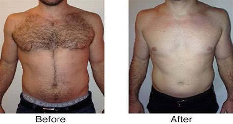 It may or may not be accompanied by an infection of the hair follicle (folliculitis) or razor bumps (pseudofolliculitis barbae), which vary in size. the-best-recipe-for-removing-unpleasant-body-hair-from ...
