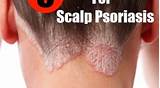 Scalp Psoriasis Diet Treatment Pictures