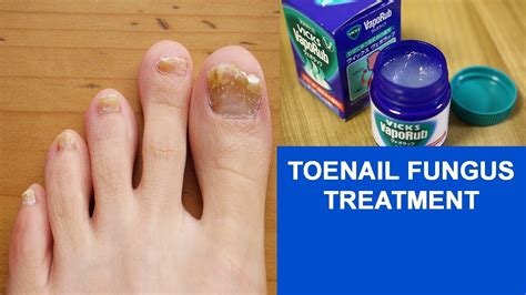 Nail Fungus Treatment At Home What Is Best Treatment For Toenail Fungus