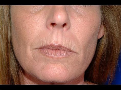 This is usually caused by hot food or beverages, such as drinking black coffee. How To Get Rid Of Laugh Lines And Wrinkles Around Mouth ...