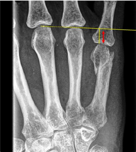 Ap Measurement Of A Subcapital Fracture Of The 5th Metacarpal Showing A