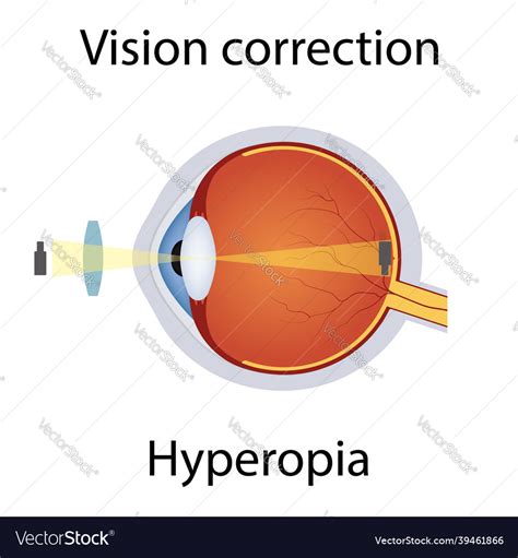 Vision Correction Of Hyperopia Royalty Free Vector Image