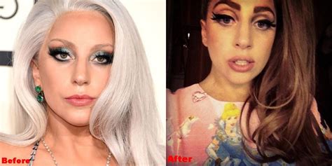 Lady Gaga Lip Injections Before And After Photos