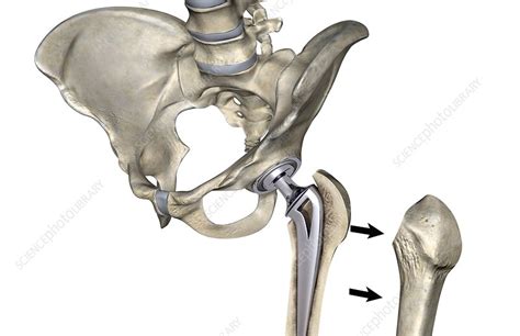 Hip Replacement Stock Image C008 1239 Science Photo Library