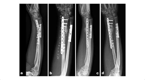 Radial Nonunion A Preoperative Radiograph B Radiograph At The