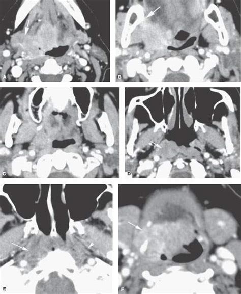 Oropharynx Malignant Tumors Radiology Key