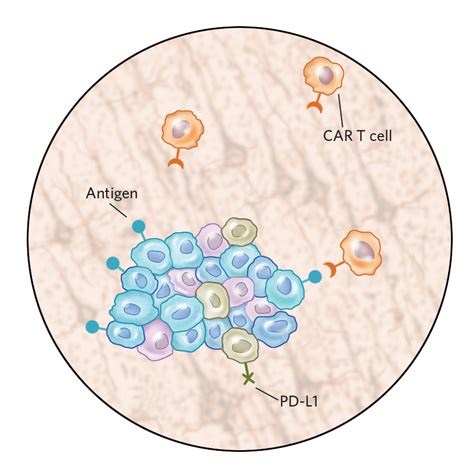 Infographic Car T Cells In Solid Versus Liquid Cancers The Scientist