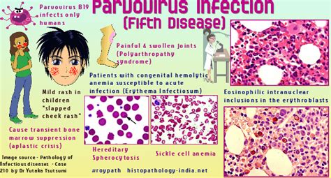 Pathology Of Parvovirus B19 Infection Fifth Disease Dr Sampurna Roy