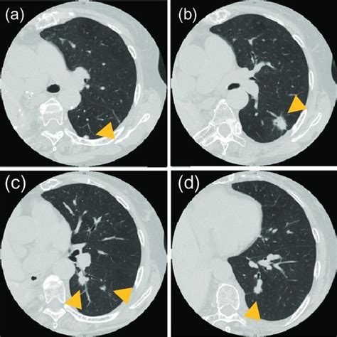 Ct Shows Five Nodules In The Left Lower Lobe Tumor Sizes And