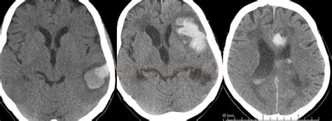 Management Of Intracerebral Hemorrhage Stroke Manual