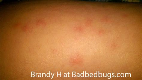 Bedbug Bites Discussion Pg 1