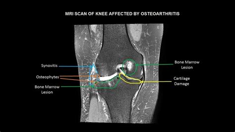 Understanding The Painful Progression Of Osteoarthritis