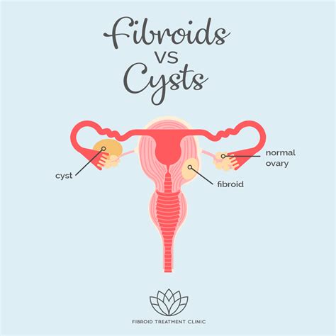 Fibroids Vs Cysts Fibroid Treatment Clinic